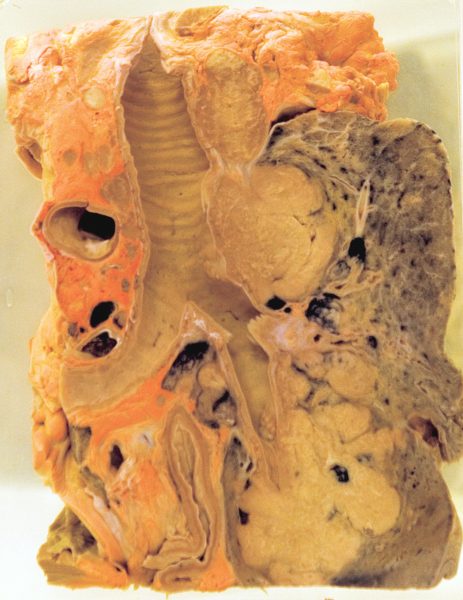 Lung tumour sufferers were once encouraged to eat carrots (which contain the orange pigment beta carotene) to fight the disease. This lung shows pigment in the surrounding fat tissue.